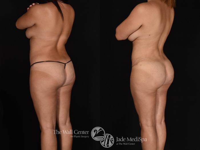 Abdominoplasty with SAFELipo & Fat Grafting Back Left Oblique Photo, Shreveport, LA, The Wall Center for Plastic Surgery, Case 858