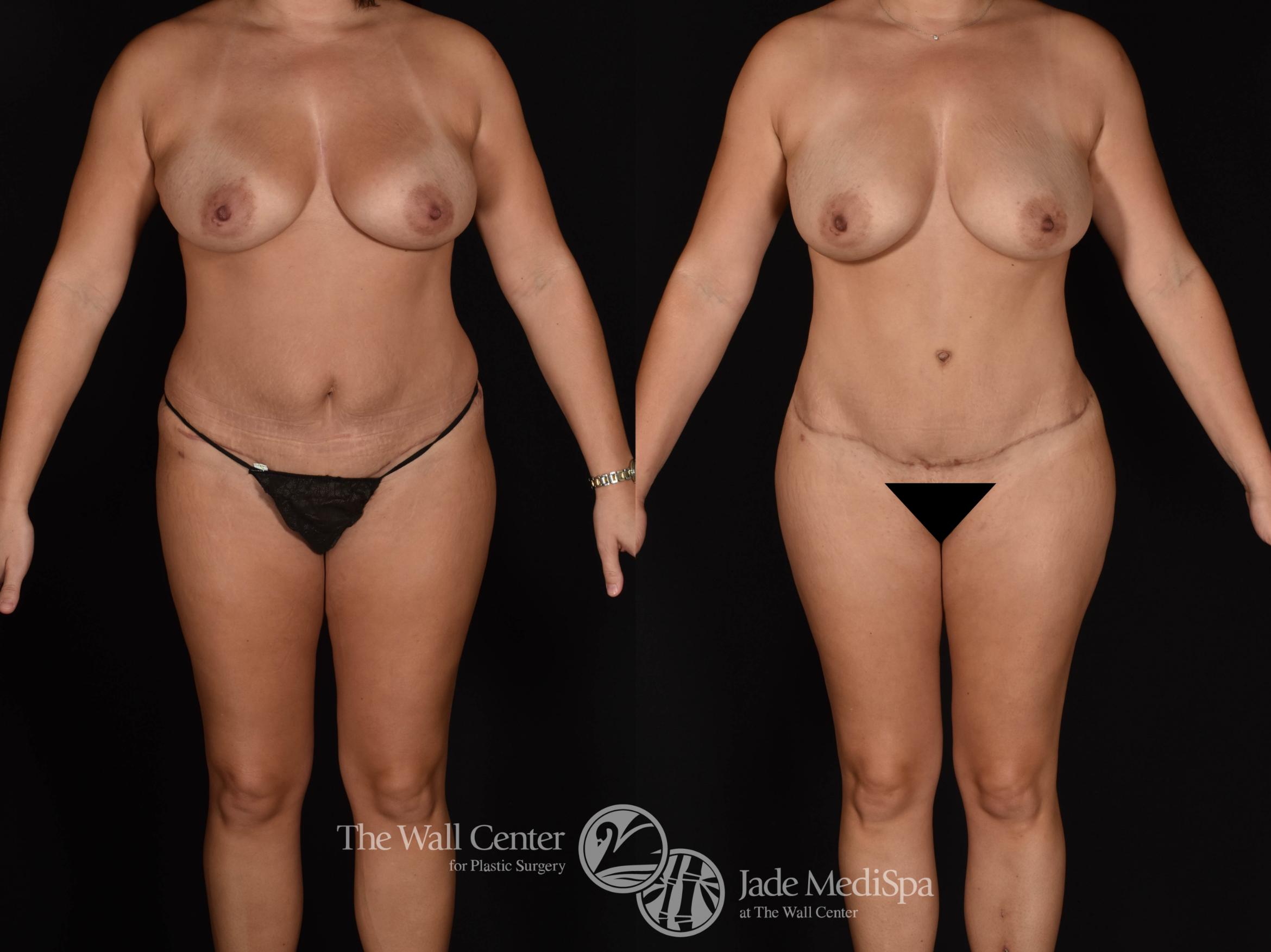 Abdominoplasty with SAFELipo & Fat Grafting Front Photo, Shreveport, LA, The Wall Center for Plastic Surgery, Case 858