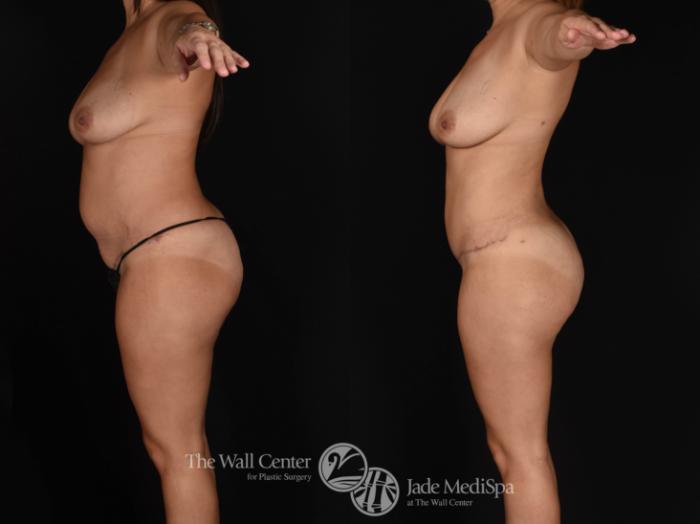 Abdominoplasty with SAFELipo & Fat Grafting Left Side Photo, Shreveport, LA, The Wall Center for Plastic Surgery, Case 858