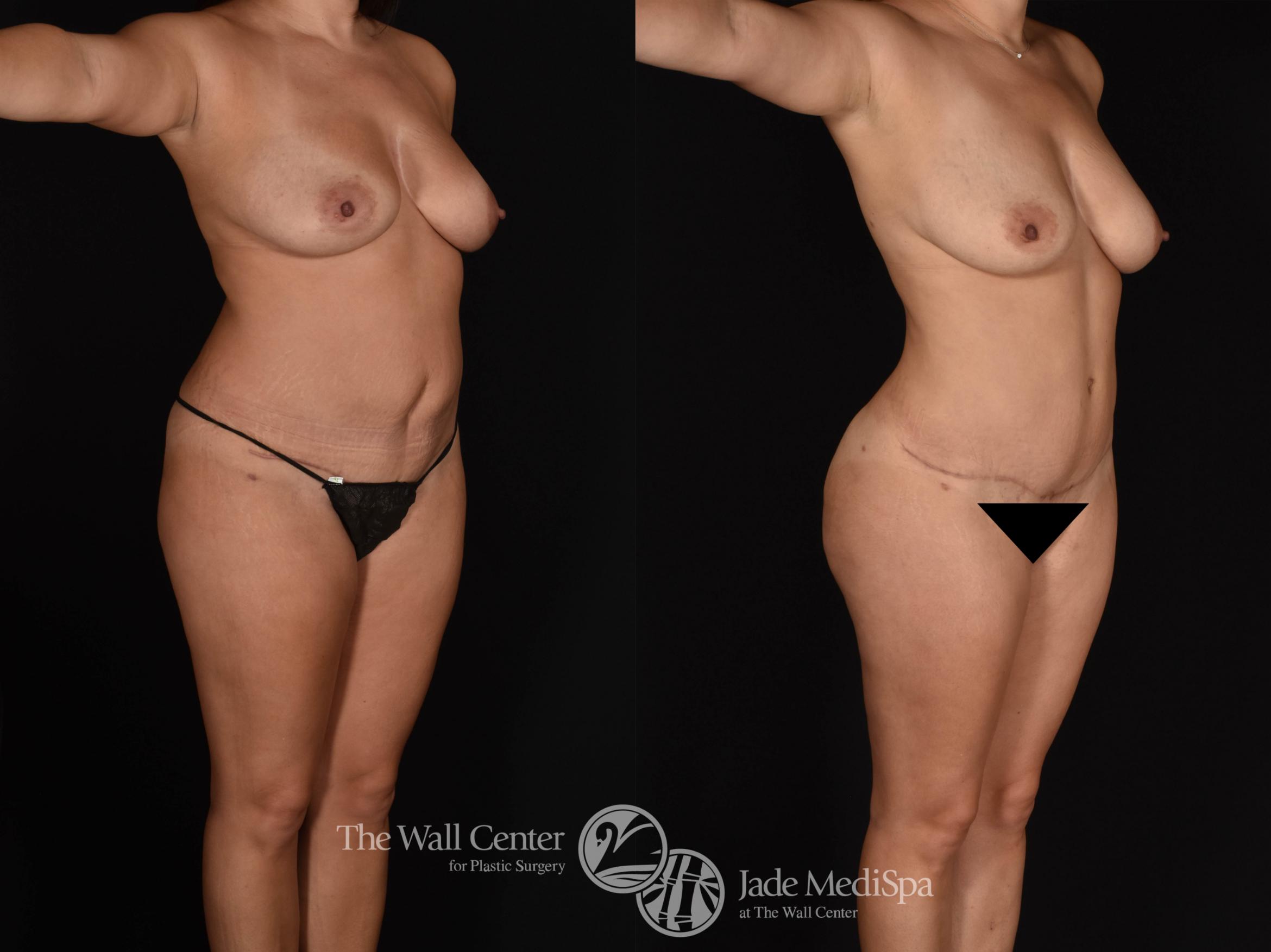 Abdominoplasty with SAFELipo & Fat Grafting Right Oblique Photo, Shreveport, LA, The Wall Center for Plastic Surgery, Case 858