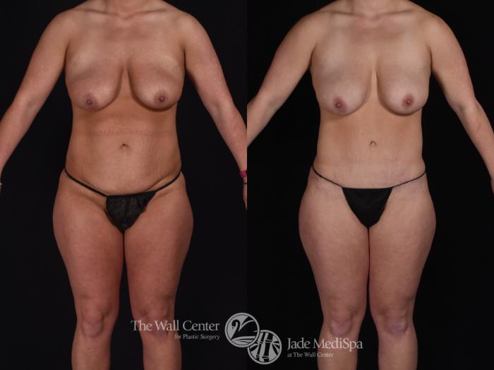 Abdominoplasty Front Photo, Shreveport, LA, The Wall Center for Plastic Surgery, Case 874
