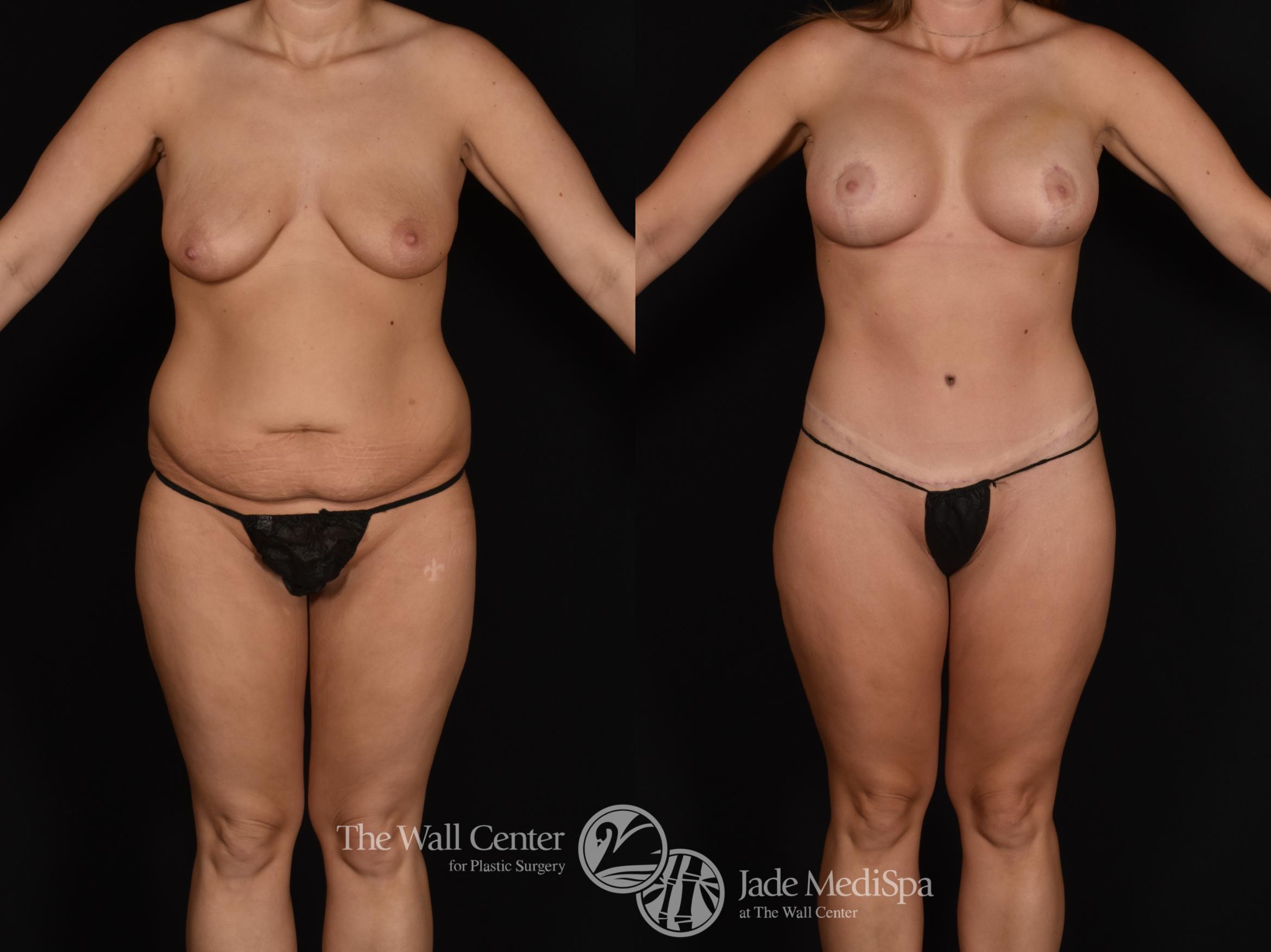 Abdominoplasty with SAFELipo Front Photo, Shreveport, LA, The Wall Center for Plastic Surgery, Case 883