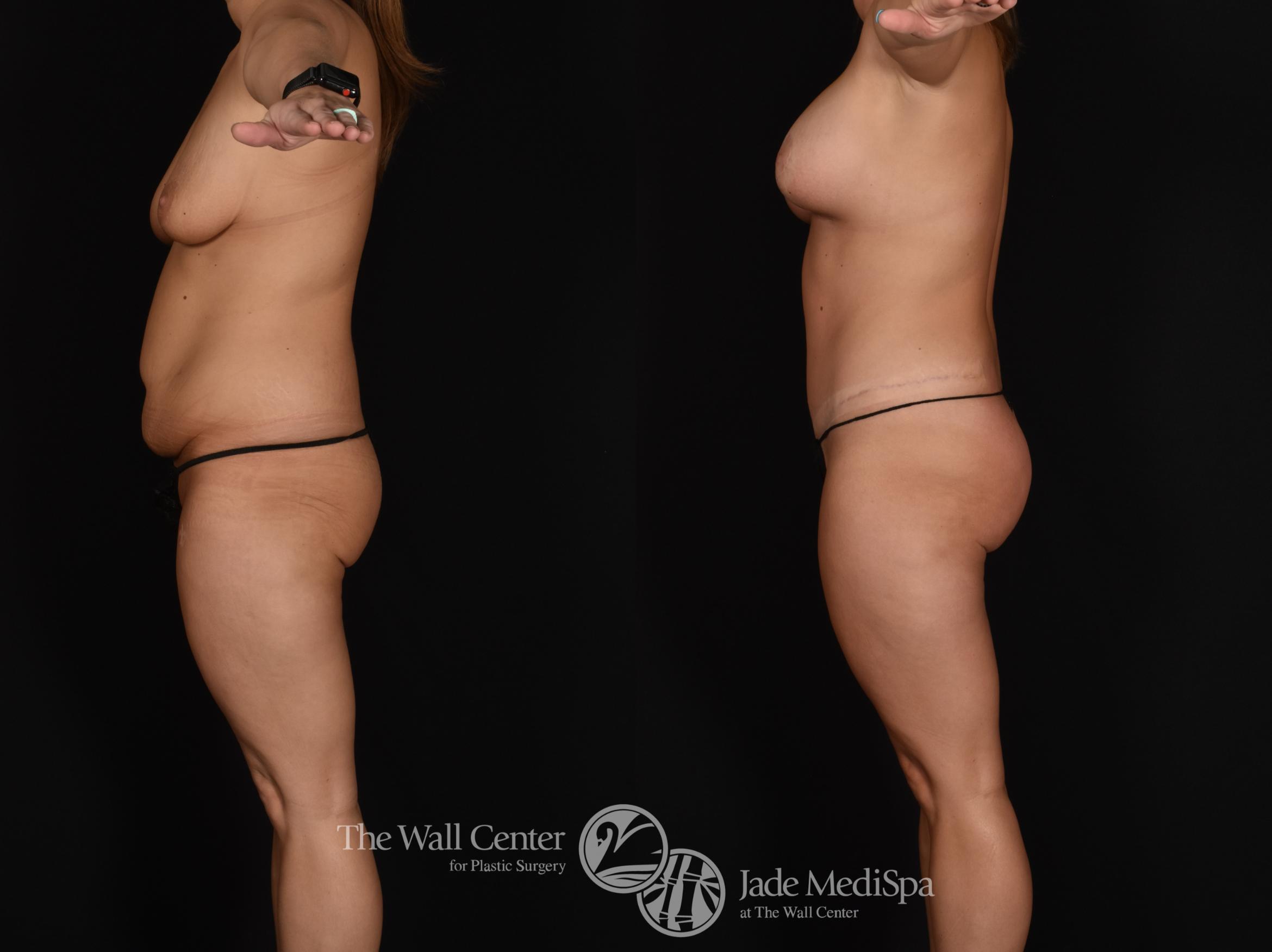 Abdominoplasty with SAFELipo Left Side Photo, Shreveport, LA, The Wall Center for Plastic Surgery, Case 883