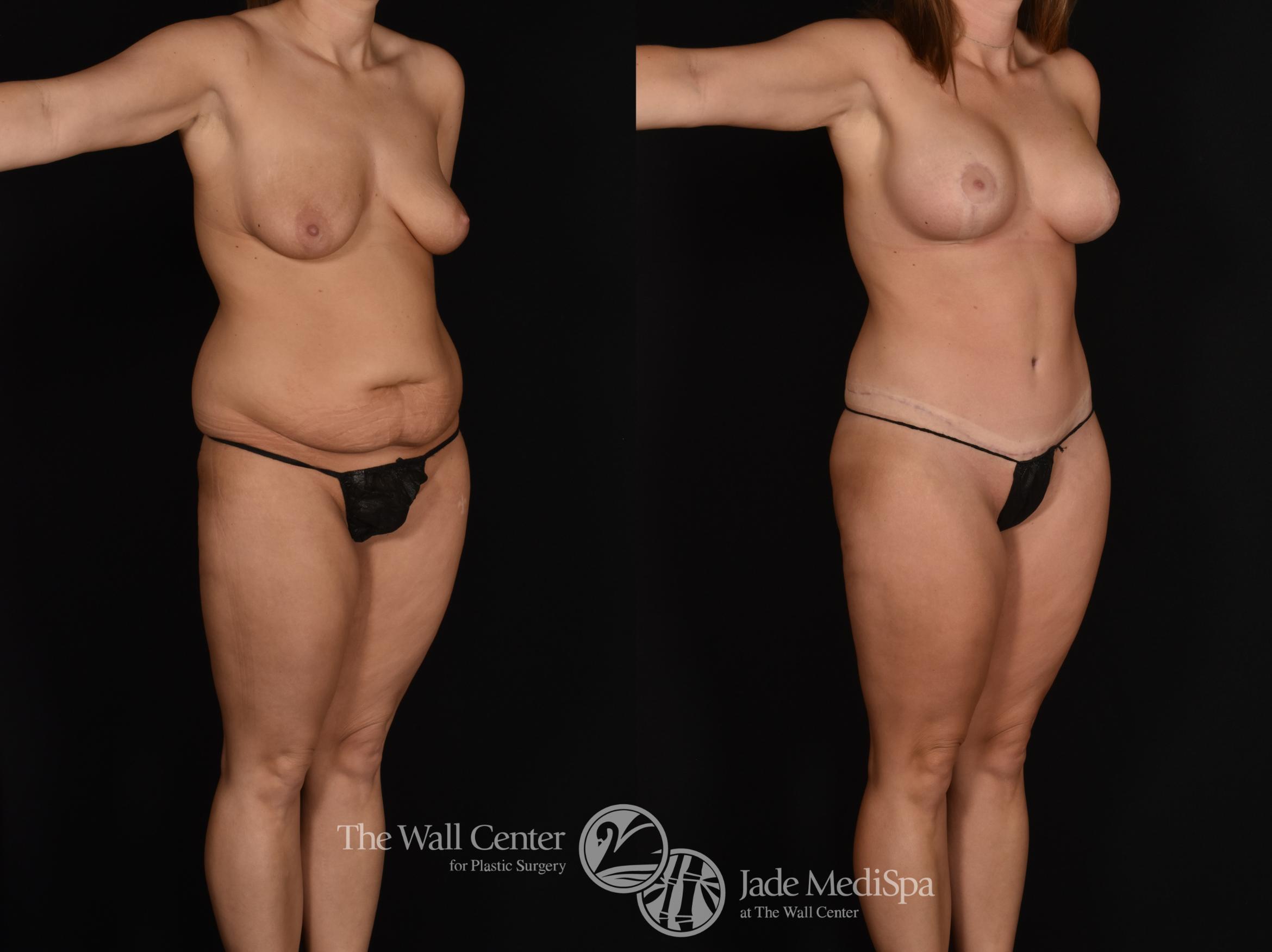 Abdominoplasty with SAFELipo Right Oblique Photo, Shreveport, LA, The Wall Center for Plastic Surgery, Case 883