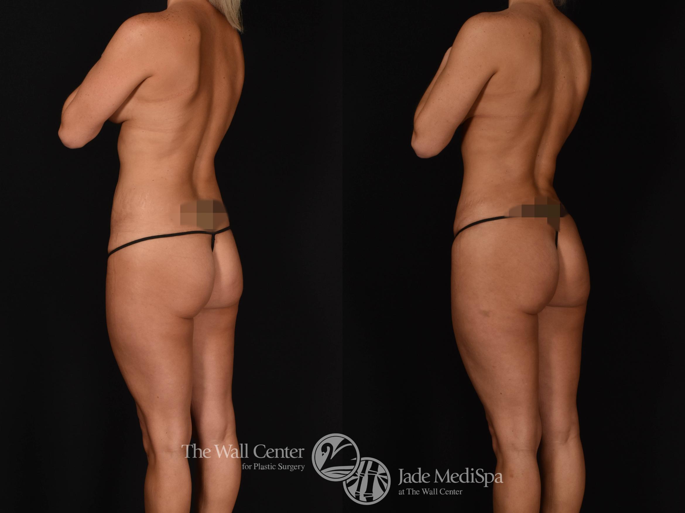 Abdominoplasty with SAFELipo & Fat Grafting Back Left Oblique Photo, Shreveport, LA, The Wall Center for Plastic Surgery, Case 927