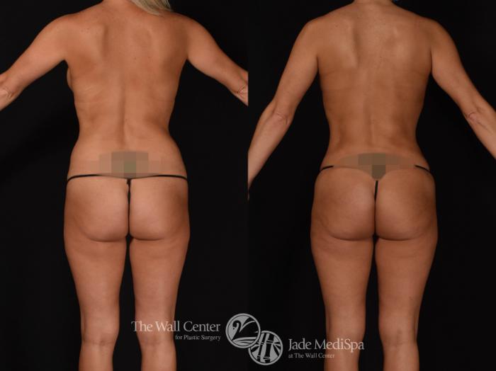 Abdominoplasty with SAFELipo & Fat Grafting Back Photo, Shreveport, LA, The Wall Center for Plastic Surgery, Case 927