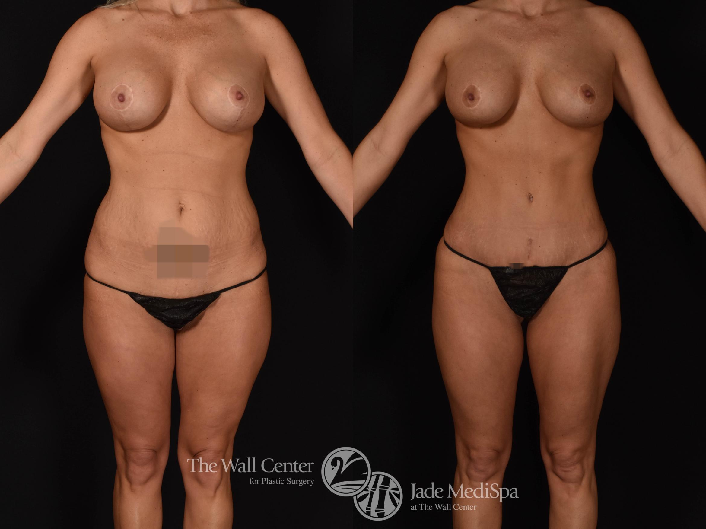 Abdominoplasty with SAFELipo & Fat Grafting Front Photo, Shreveport, LA, The Wall Center for Plastic Surgery, Case 927