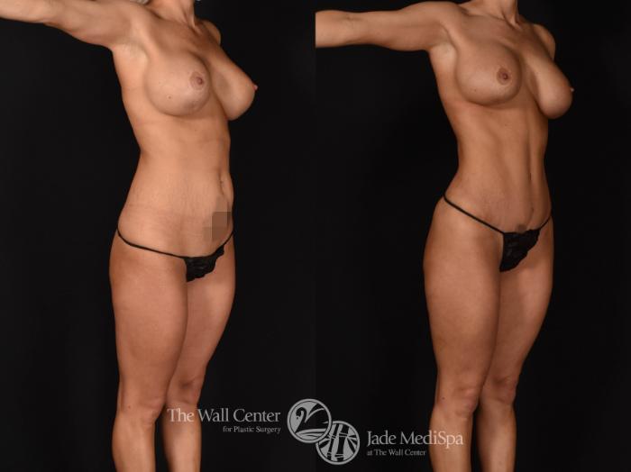 Abdominoplasty with SAFELipo & Fat Grafting Right Oblique Photo, Shreveport, LA, The Wall Center for Plastic Surgery, Case 927