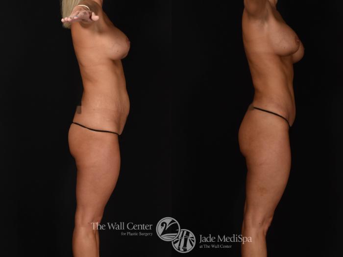 Abdominoplasty with SAFELipo & Fat Grafting Right Side Photo, Shreveport, LA, The Wall Center for Plastic Surgery, Case 927