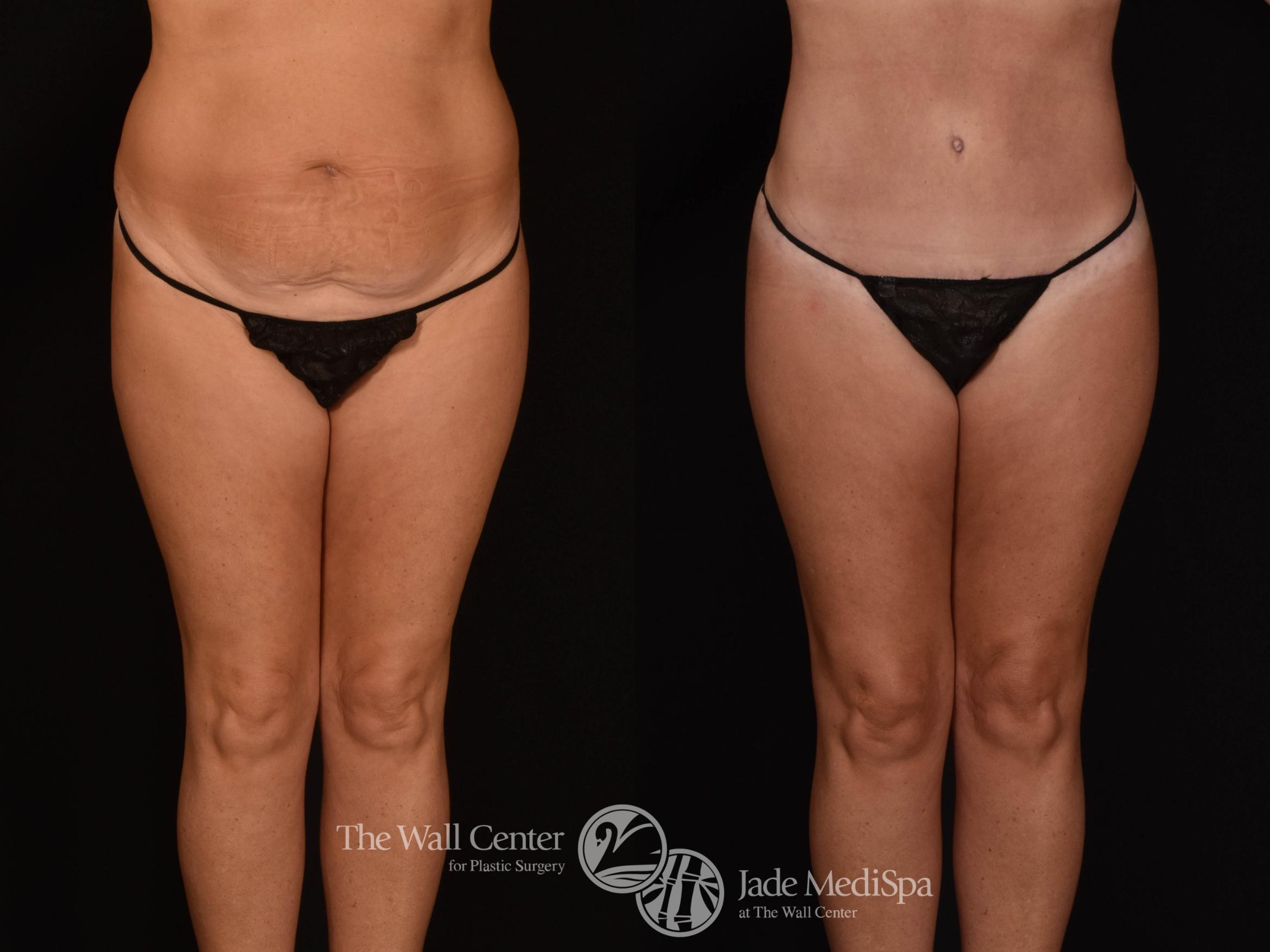 Abdominoplasty with SAFELipo Front Photo, Shreveport, LA, The Wall Center for Plastic Surgery, Case 932