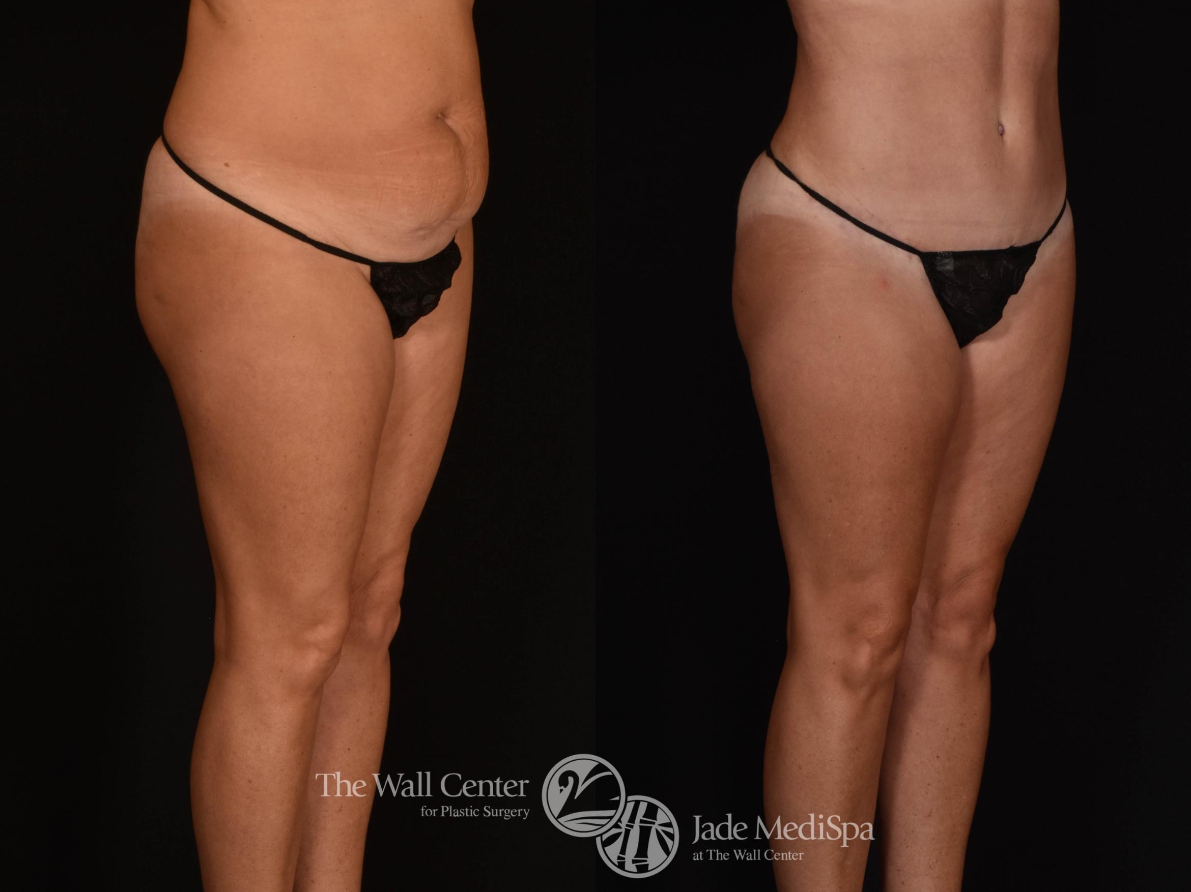 Abdominoplasty with SAFELipo Right Oblique Photo, Shreveport, LA, The Wall Center for Plastic Surgery, Case 932