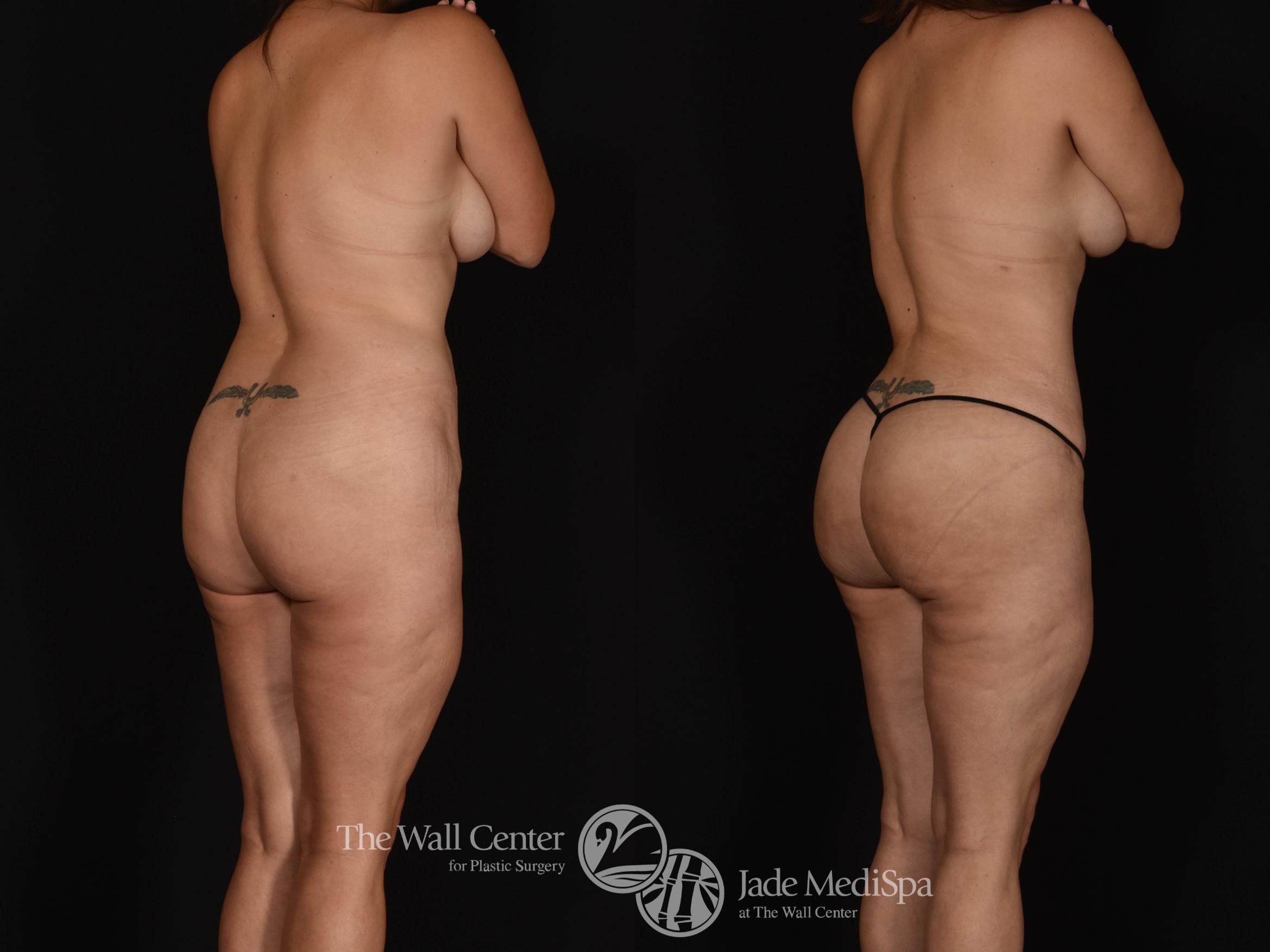 Abdominoplasty with SAFELipo & Fat Grafting Back Right Oblique Photo, Shreveport, LA, The Wall Center for Plastic Surgery, Case 955