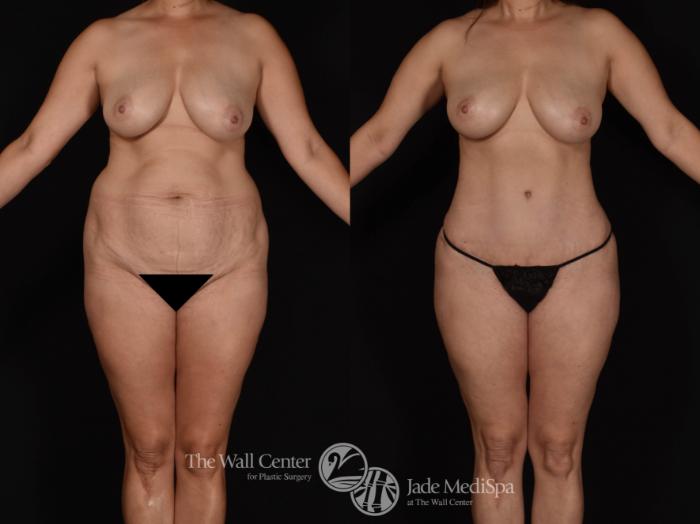 Abdominoplasty with SAFELipo & Fat Grafting Front Photo, Shreveport, LA, The Wall Center for Plastic Surgery, Case 955