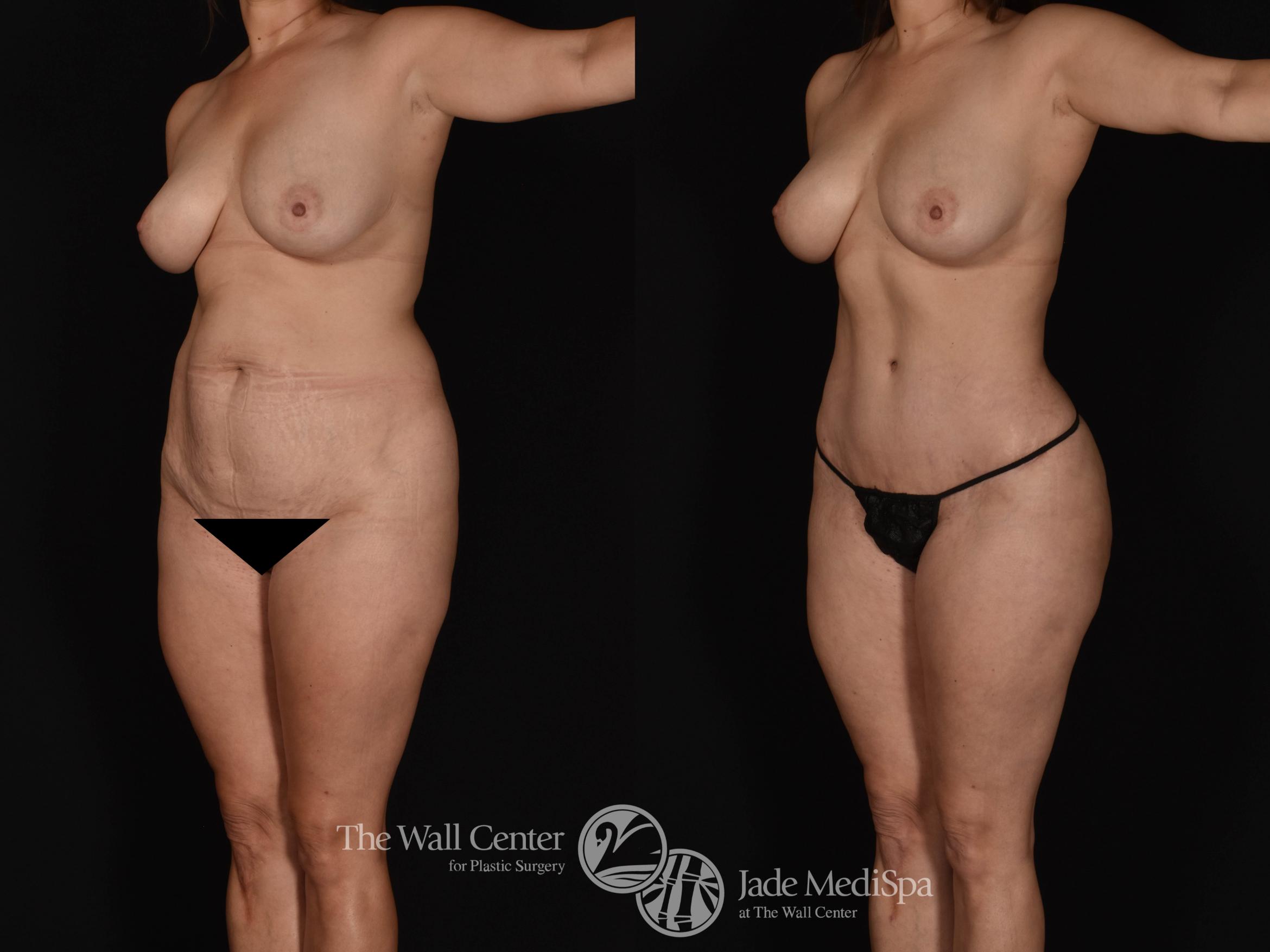 Abdominoplasty with SAFELipo & Fat Grafting Left Oblique Photo, Shreveport, LA, The Wall Center for Plastic Surgery, Case 955