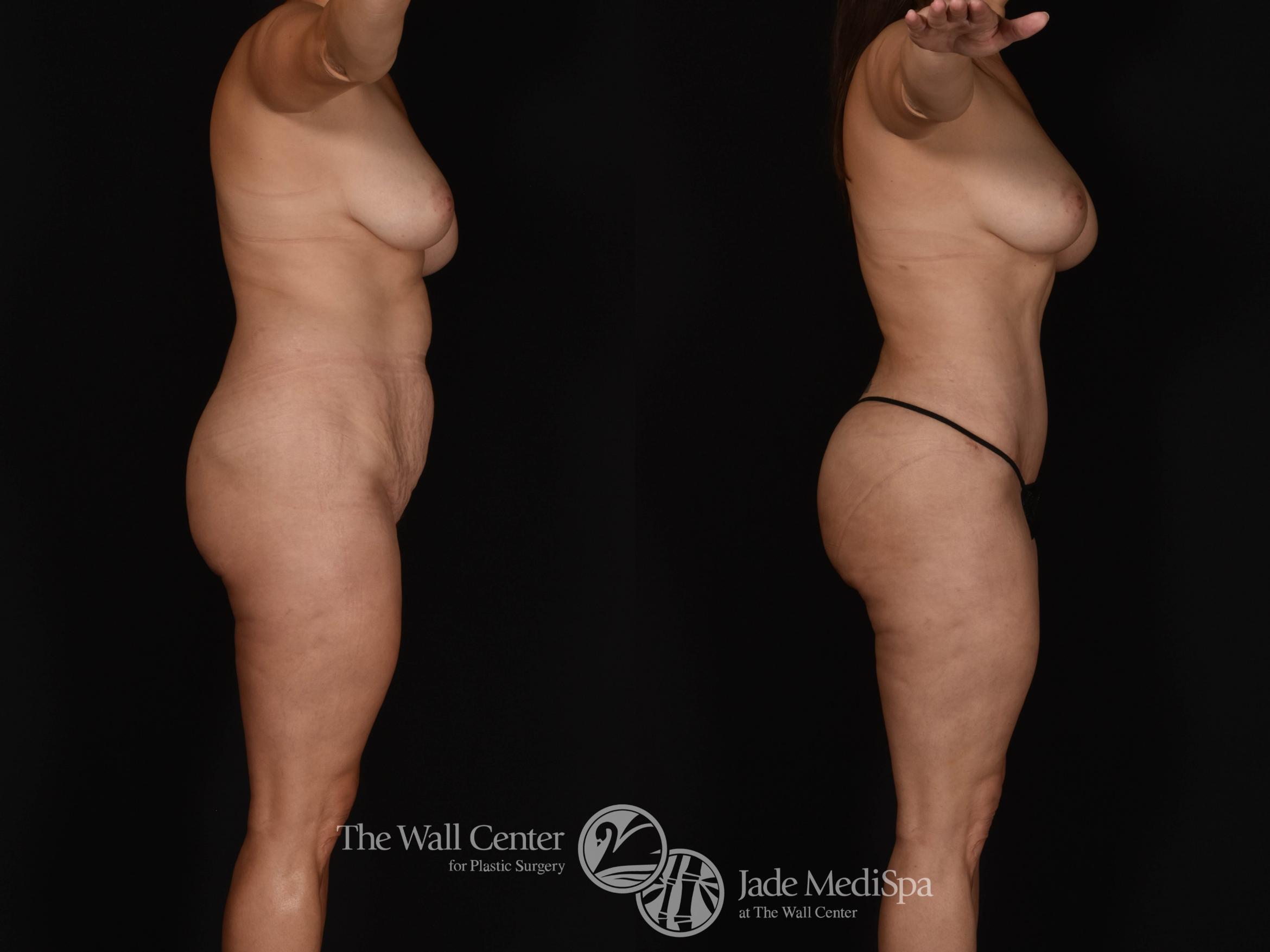 Abdominoplasty with SAFELipo & Fat Grafting Right Side Photo, Shreveport, LA, The Wall Center for Plastic Surgery, Case 955