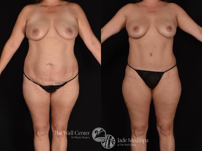 Abdominoplasty with SAFELipo Front Photo, Shreveport, LA, The Wall Center for Plastic Surgery, Case 966