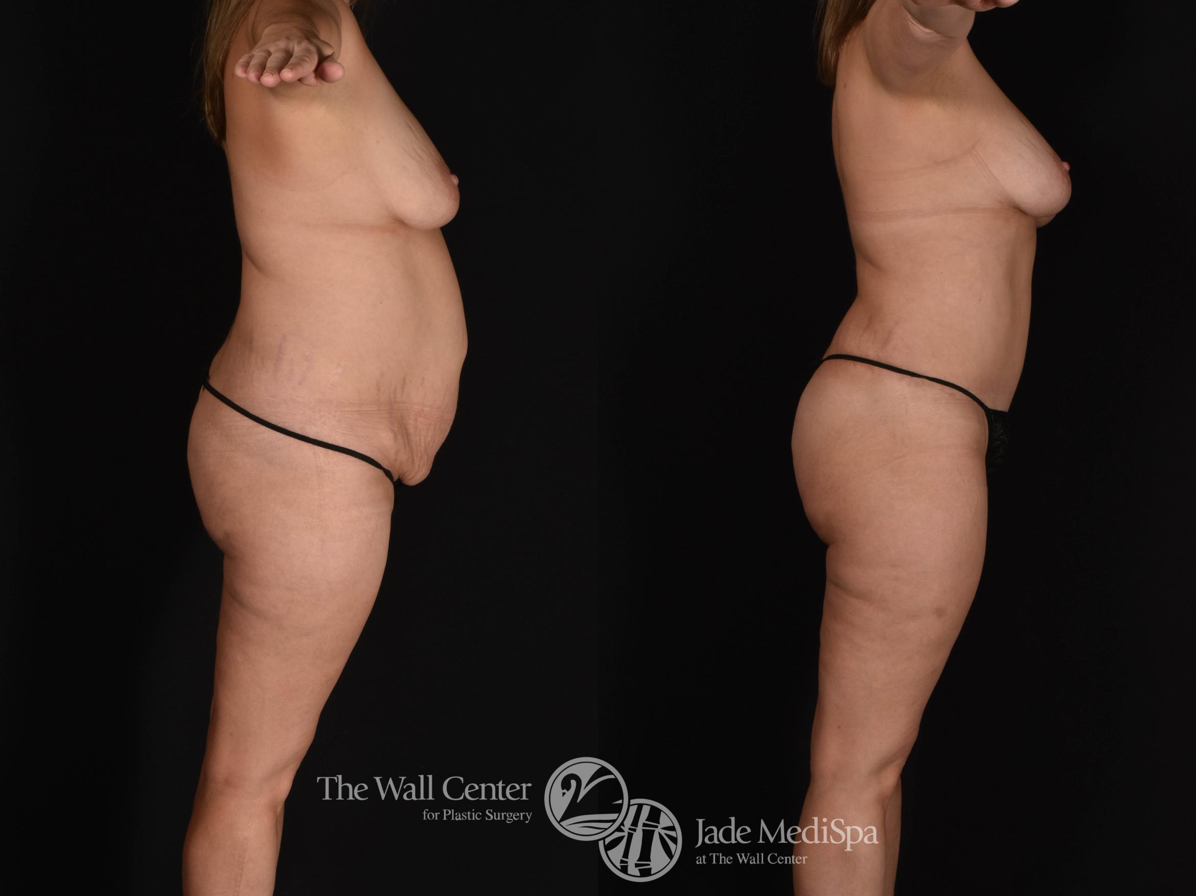 Abdominoplasty with SAFELipo Right Side Photo, Shreveport, LA, The Wall Center for Plastic Surgery, Case 966