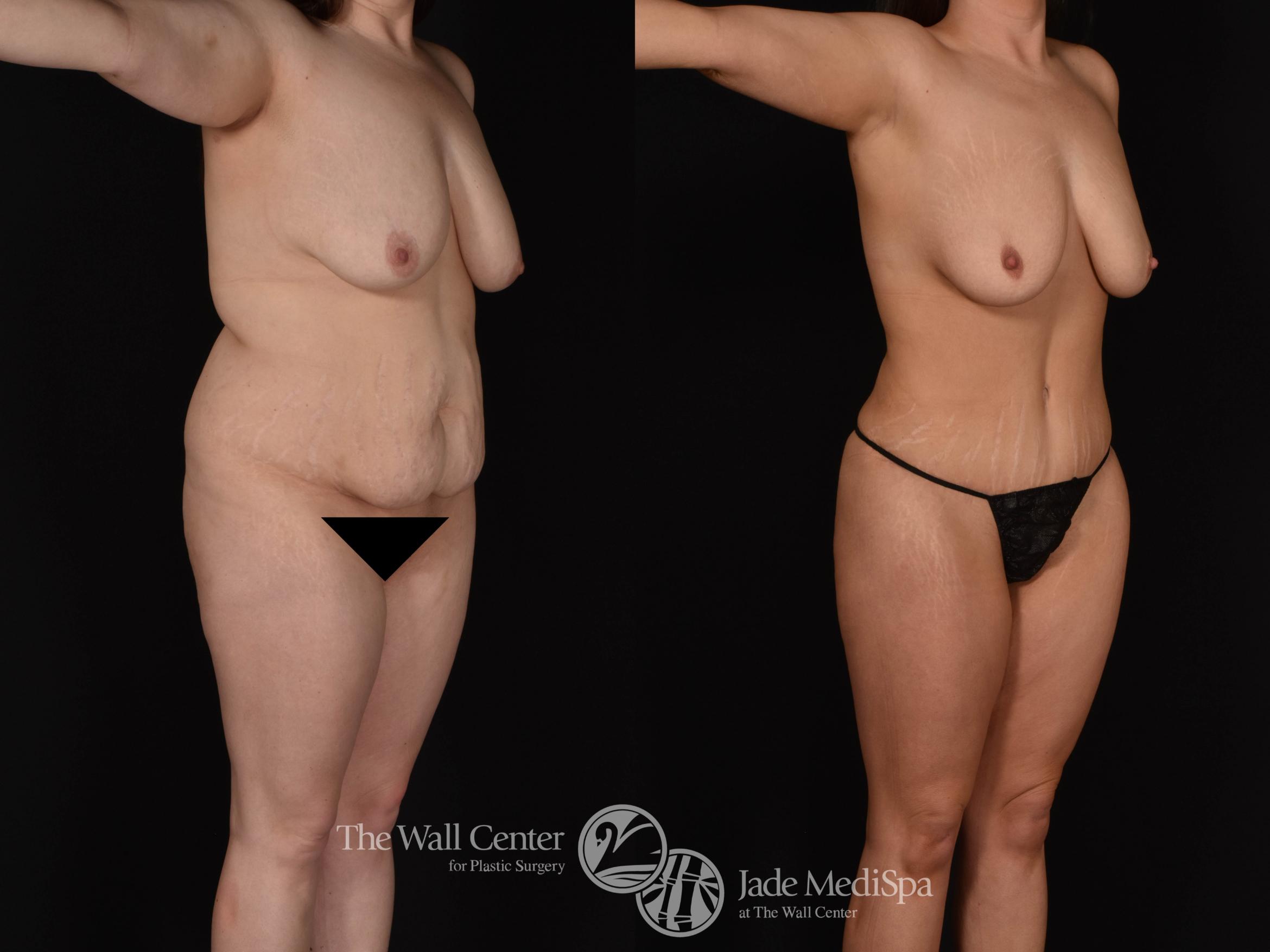 Abdominoplasty with SAFELipo Right Oblique Photo, Shreveport, LA, The Wall Center for Plastic Surgery, Case 970