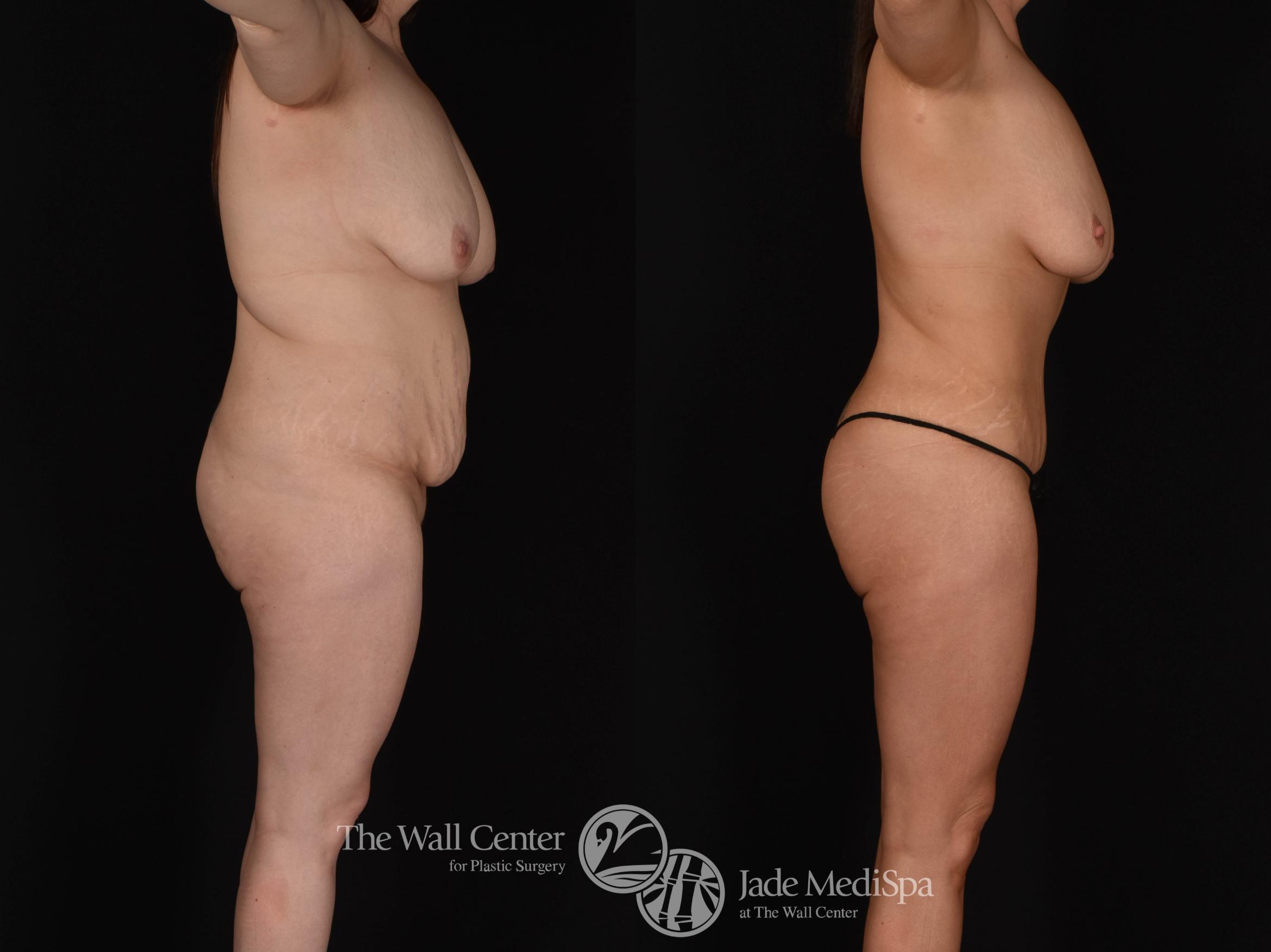 Abdominoplasty with SAFELipo Right Side Photo, Shreveport, LA, The Wall Center for Plastic Surgery, Case 970