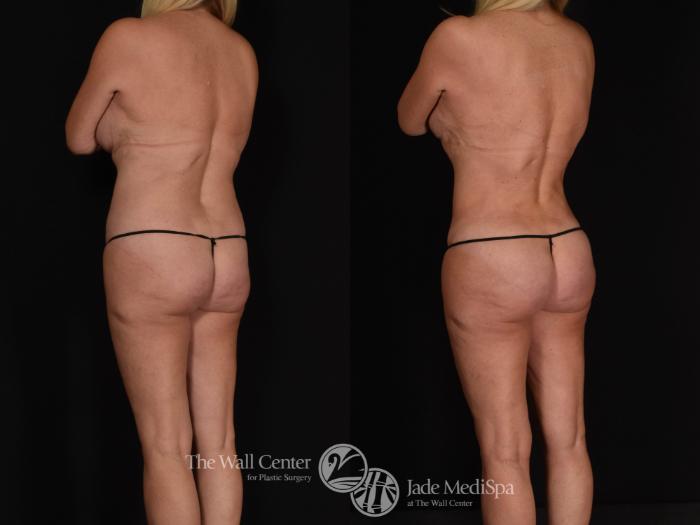 Tummy Tuck with SAFELipo and Fat Grafting to Buttocks