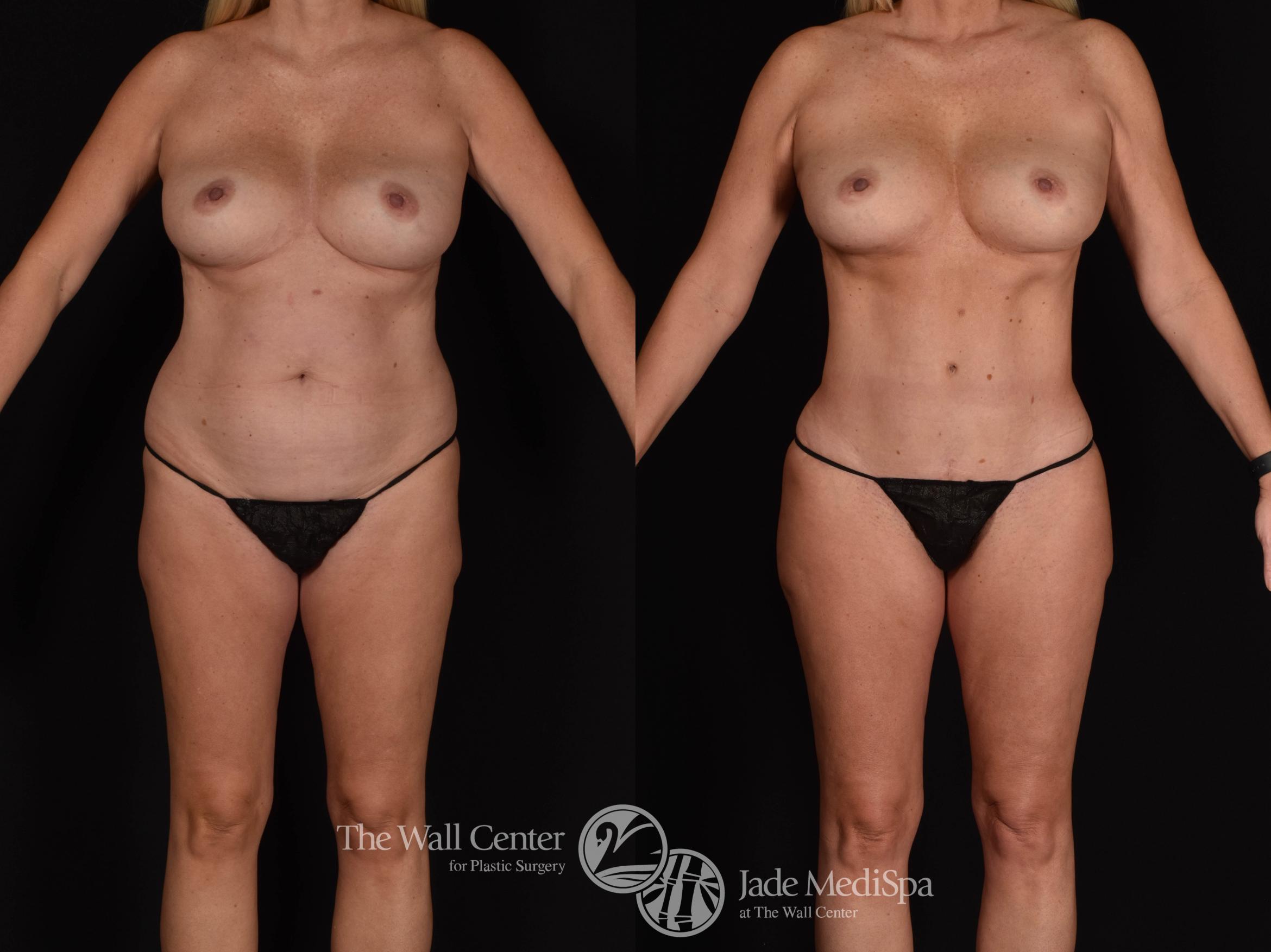 Tummy Tuck with SAFELipo and Fat Grafting to Buttocks