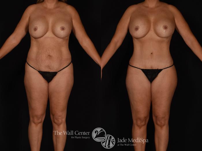 Before & After Tummy Tuck Case 983 Front View in Shreveport, LA