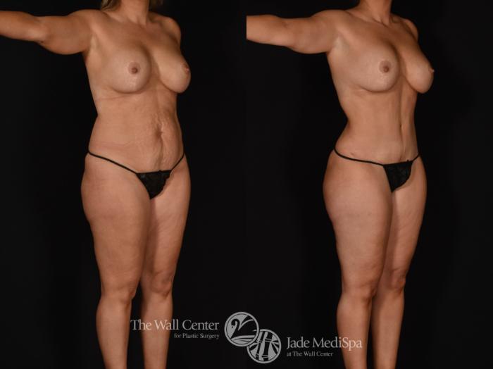 Before & After Tummy Tuck Case 983 Right Oblique View in Shreveport, LA