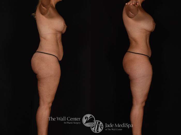 Before & After Tummy Tuck Case 983 Right Side View in Shreveport, LA