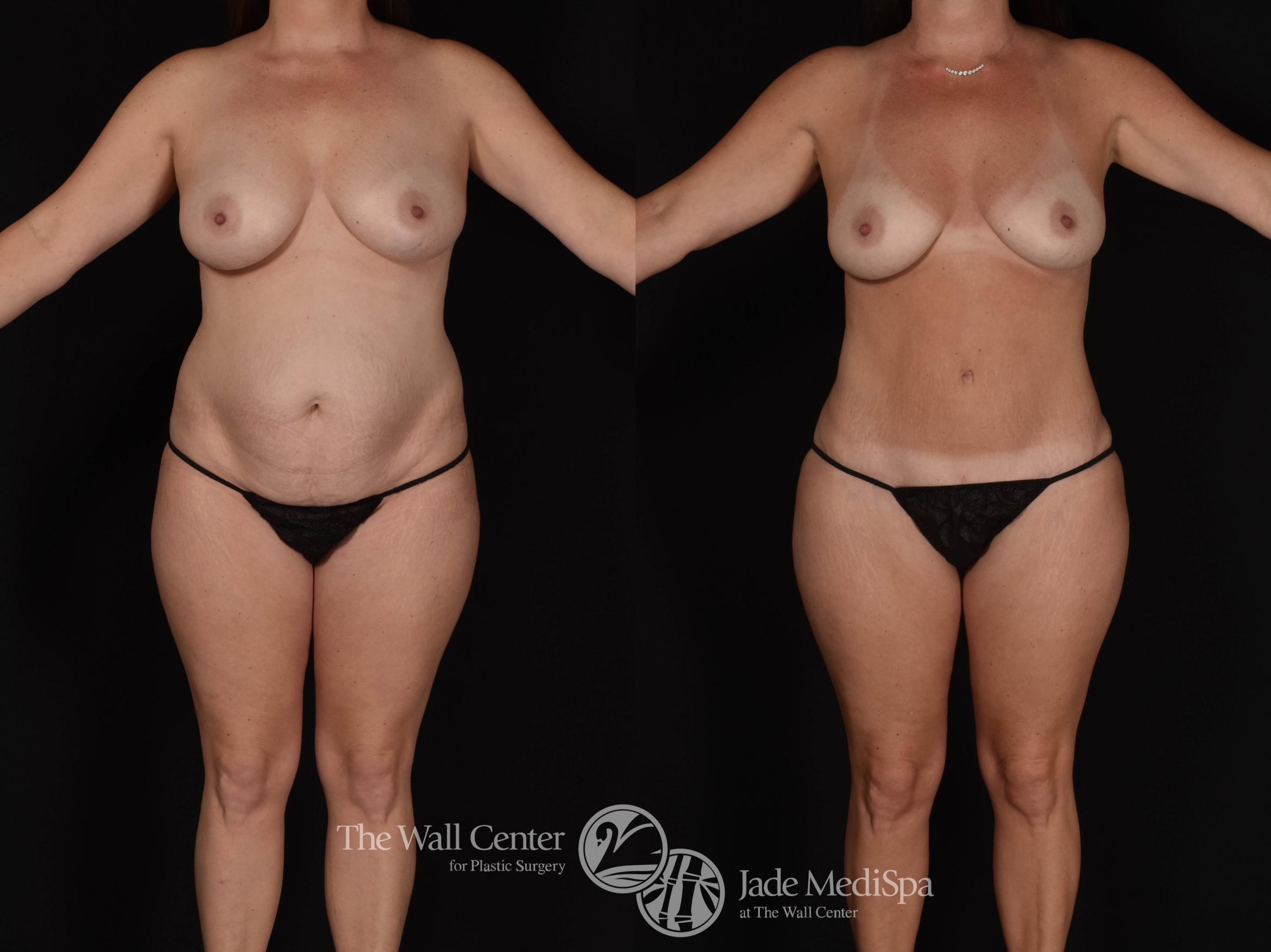 Before & After Tummy Tuck Case 987 Front View in Shreveport, LA