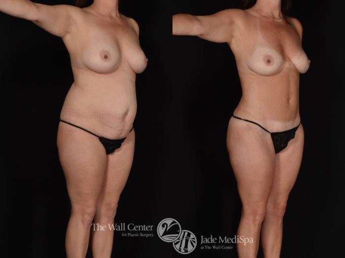 Before & After Tummy Tuck Case 987 Right Side View in Shreveport, LA