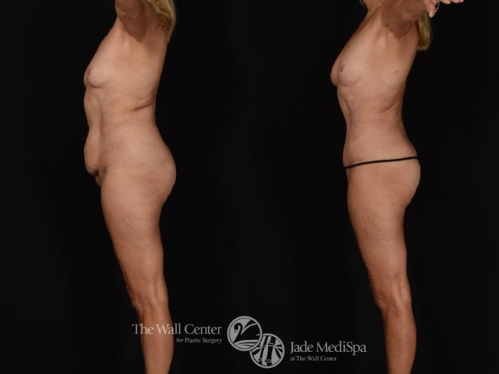 Before & After Tummy Tuck Case 988 Left Side View in Shreveport, LA
