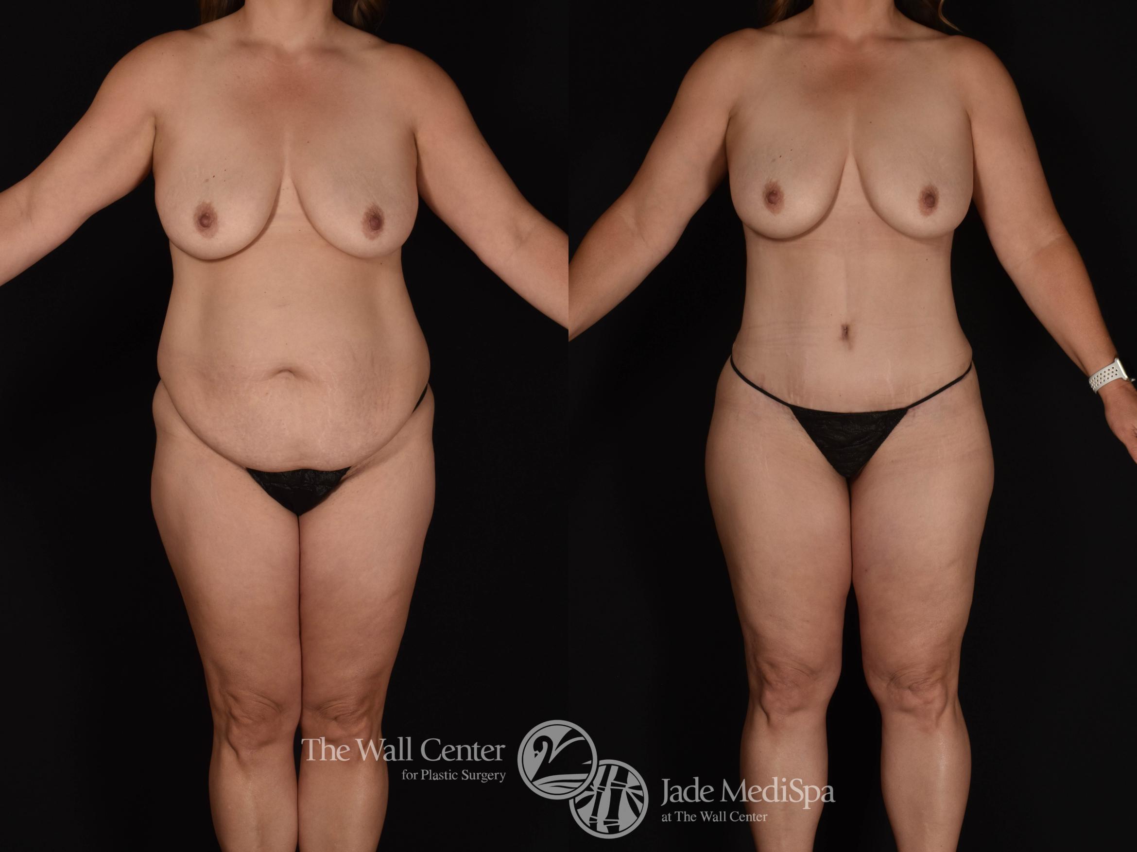 Before & After Tummy Tuck Case 989 Front View in Shreveport, LA