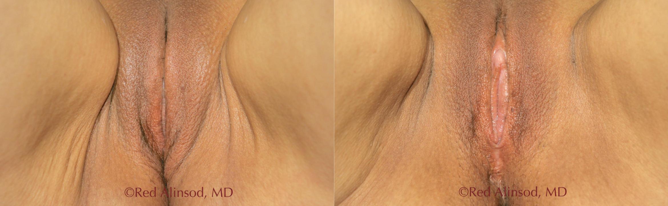 Before & After Vaginal Rejuvenation Case 512 View #1 View in Shreveport, LA