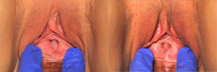 Before & After Vaginal Rejuvenation Case 514 View #1 View in Shreveport, LA