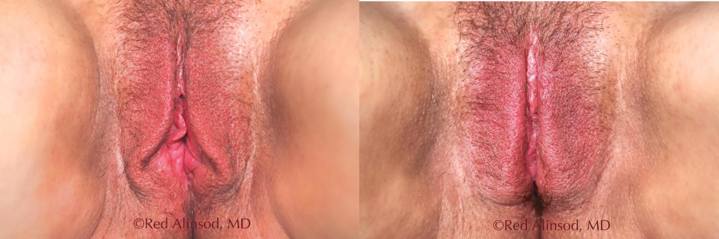 Before & After Vaginal Rejuvenation Case 515 View #1 View in Shreveport, LA