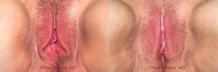 Before & After Vaginal Rejuvenation Case 515 View #2 View in Shreveport, LA